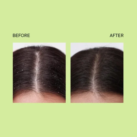 Quench Tea Tree Dandruff Control Ampoule pic 5